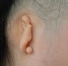 小耳畸形有哪些表现