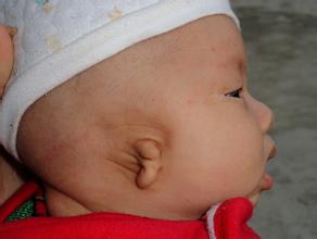 外耳道闭锁原因