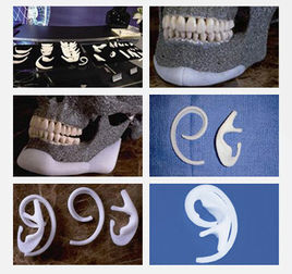 Medpor一次性耳畸形矫正