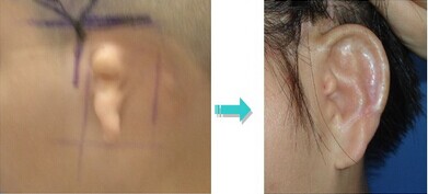 小耳畸形矫正