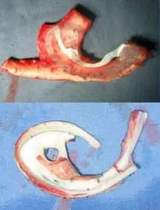 上海全耳再造术会存在哪些危害吗