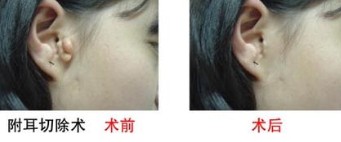 附耳整形安全吗