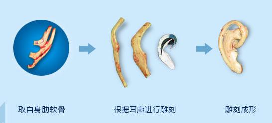 自体软骨造耳的优点有哪些