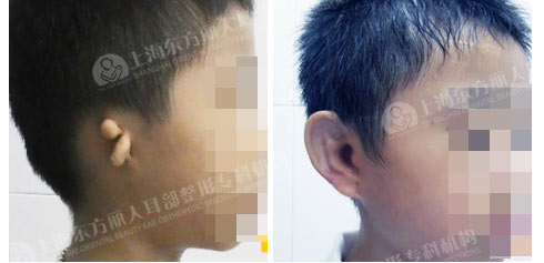 上海自体肋软骨造耳手术要多少钱