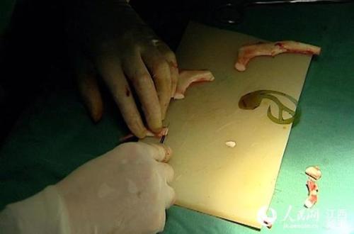 上海做小耳畸形再造手术前要注意什么