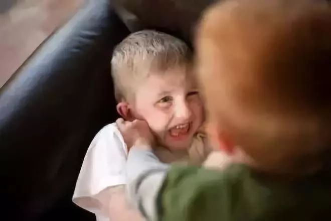 小耳畸形千万不要错过最佳治疗年龄