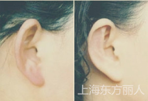 招风耳整形效果图
