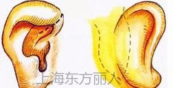 杯状耳整形