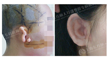 东方丽人全耳再造术