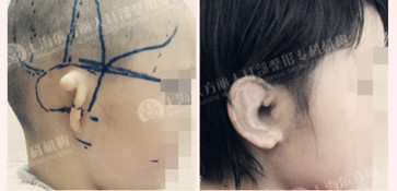 耳部畸形找麻烦，该怎么办