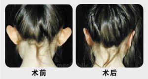 招风耳矫正