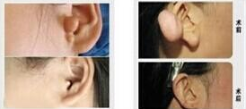 附耳切除术效果
