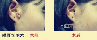 附耳整形