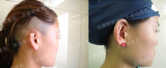 耳缺损手术修复方法