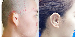 小耳畸形矫正4大优势