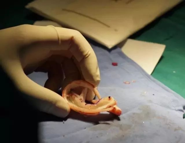 耳再造手术一般要花多少钱