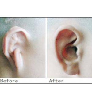 耳部整形帮你矫正小耳畸形