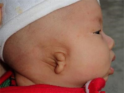 先天性小耳畸形