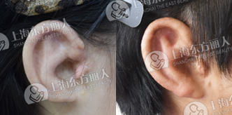 人造耳朵多少钱